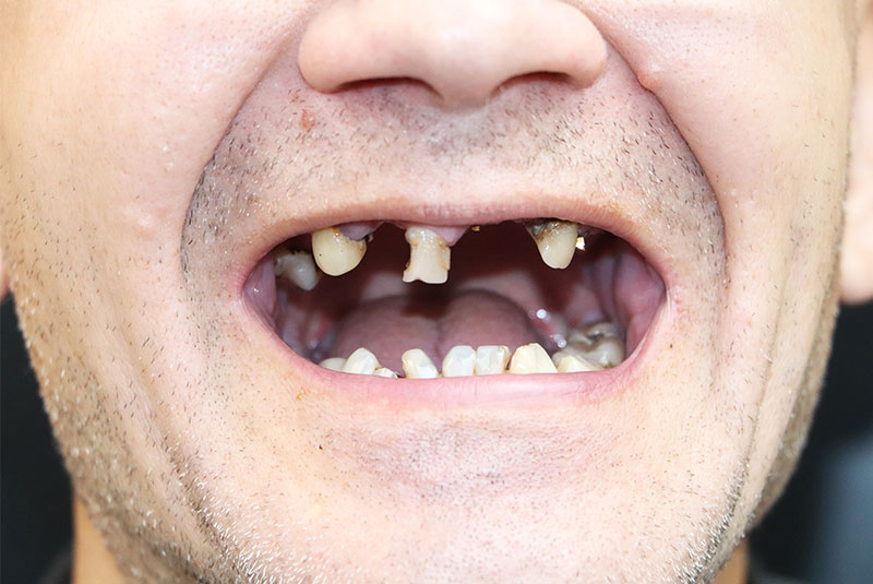 Before image of dental procedure of patient