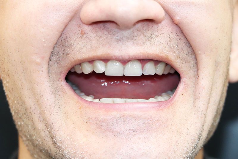 after photo of patient dental implant procedure