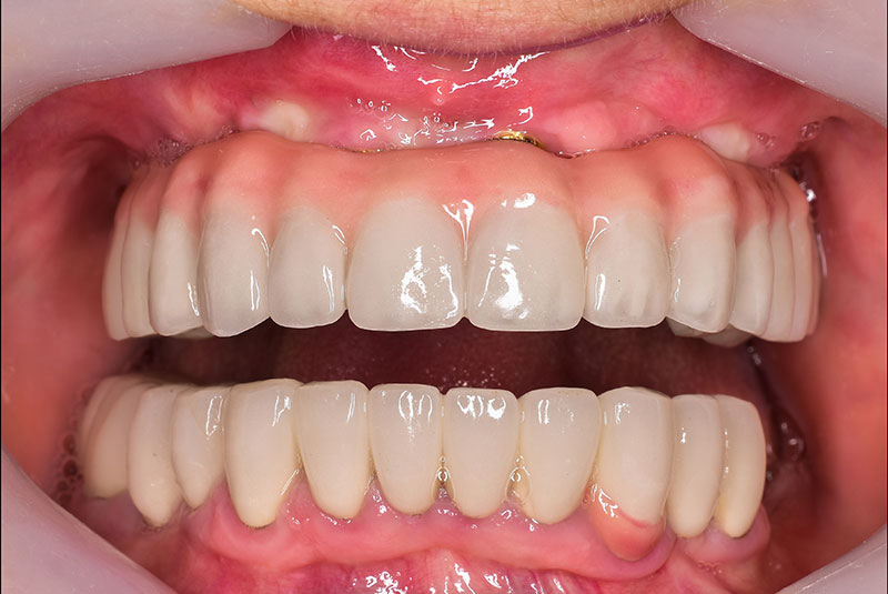 after photo of patient dental implant procedure
