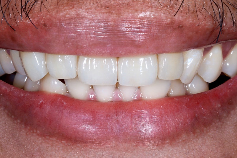 after photo of patient dental implant procedure