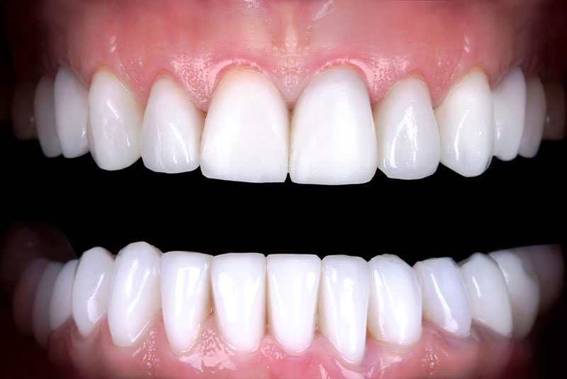 after photo of patient dental implant procedure