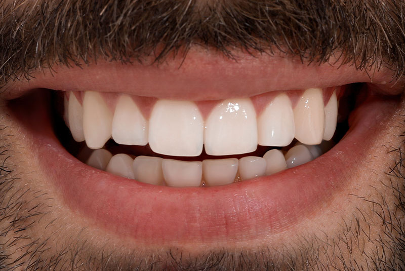 after photo of patient dental implant procedure