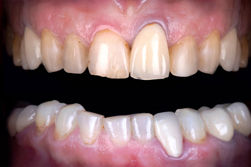 Before image of dental procedure of patient