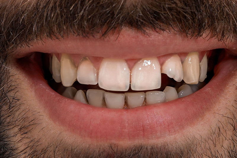 Before image of dental procedure of patient
