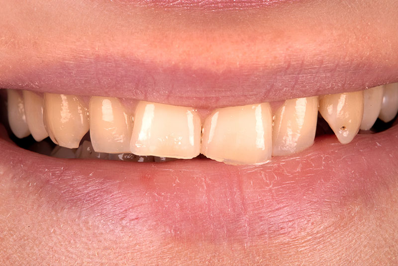 Before image of dental procedure of patient