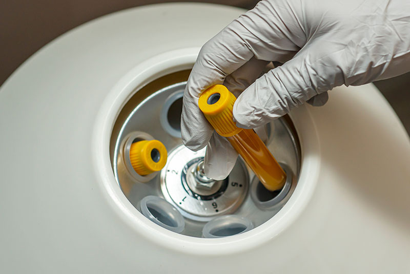 platelet-rich plasma protein concentrate being placed in device for treatments