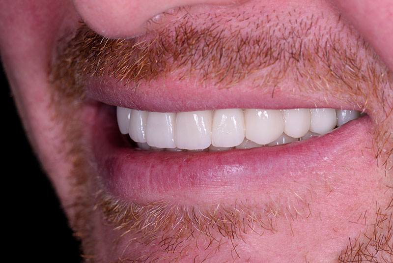 after dental procedure results