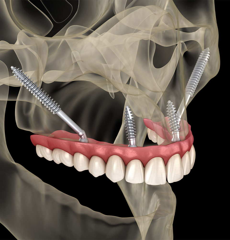zygomatic ilustration