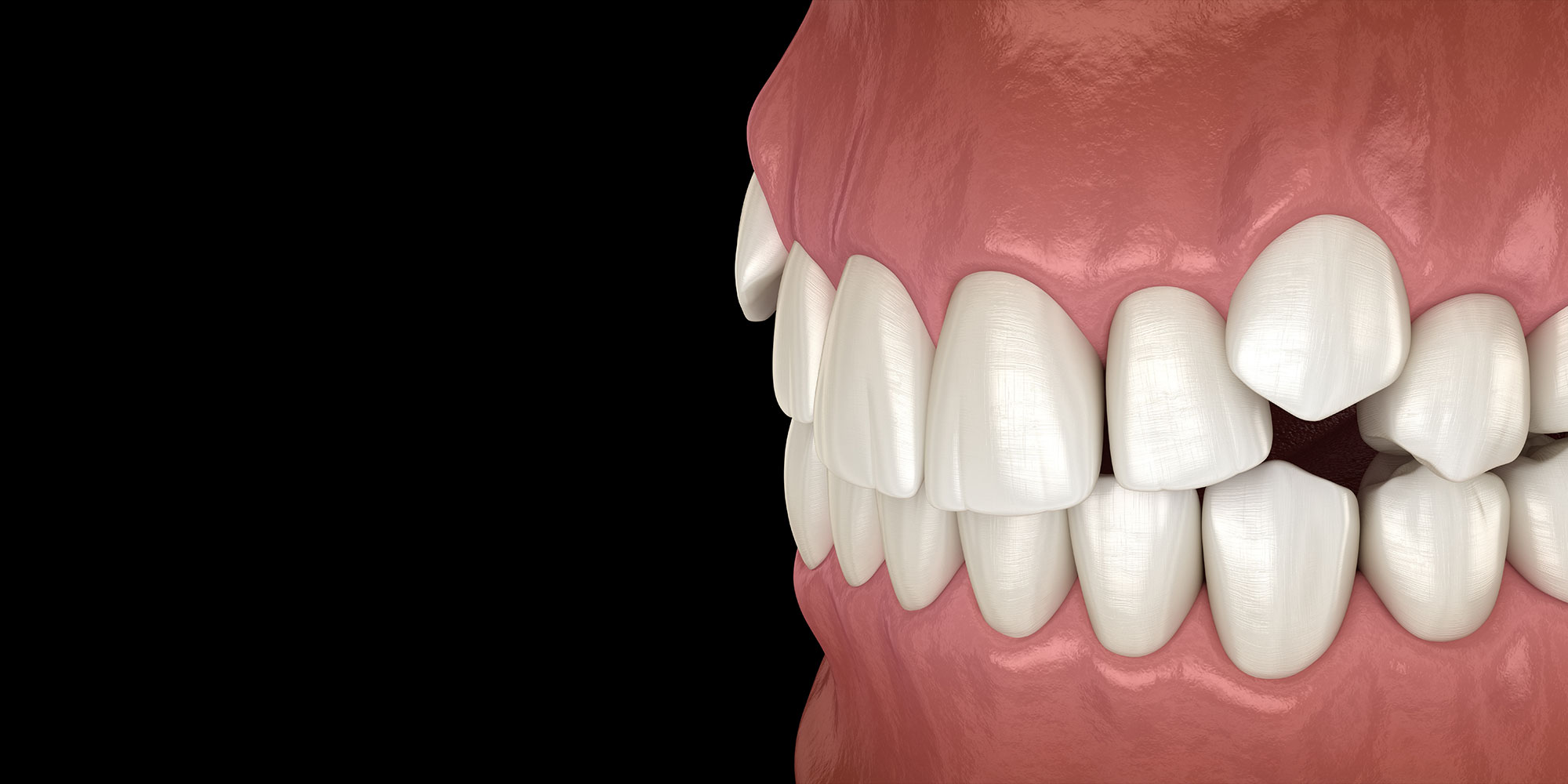 Impacted incisors, overcrowded teeth. Medically accurate 3D illustration of abnormal dental occlusion