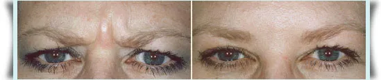 Before and After Photos: Botox Cosmetic case study