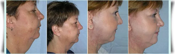 Before and After Photos: Facelift case study