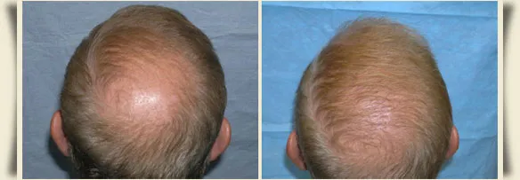 Before and After Photos: Hair transplant case study