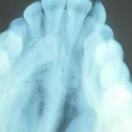 impacted tooth image 1