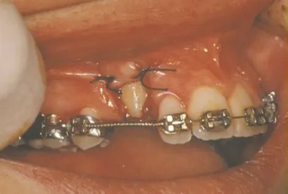 impacted tooth with braces