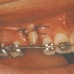 impacted tooth with braces