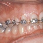 Fixed impacted tooth with braces 